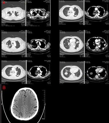 Case Report: Herceptin as a Potentially Valuable Adjuvant Therapy for a Patient With Human Epidermal Growth Factor Receptor 2-Positive Advanced Esophageal Squamous Cell Carcinoma